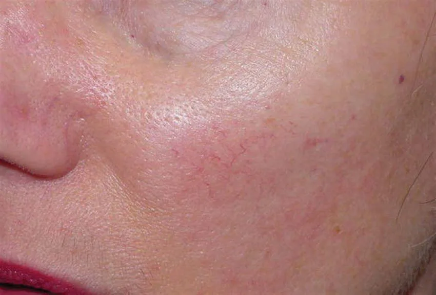 Primer plano de mejilla y ala nasal con telangiectasias faciales: finas líneas rojas ramificadas y sinuosas de calibre inferior a un milímetro sobre un fondo de eritema difuso perinasal, con poros dilatados y sin pápulas ni pústulas. La coexistencia de vasos visibles con eritema de fondo es lo que obliga a plantearse rosácea en lugar de telangiectasia aislada. Baran, Textbook of Cosmetic Dermatology, figura 54.1.